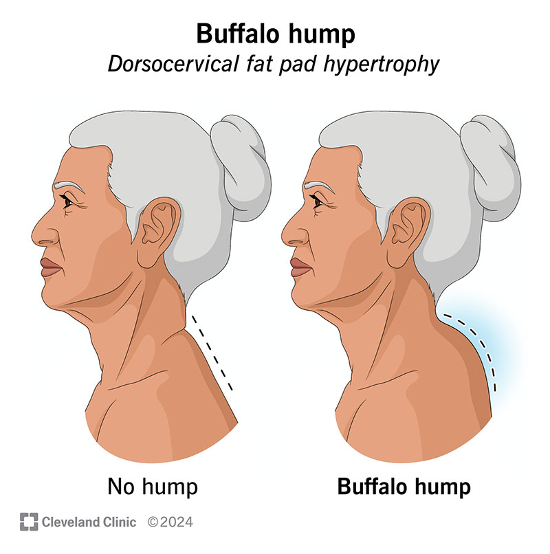 Hrčka na krku a zlé držanie tela: účinné cviky a odporúčania odborníkov