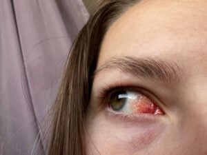 Pália vás oči alebo sú neustále červené? Skúste tieto overené triky našich babičiek, ktoré skutočne fungujú